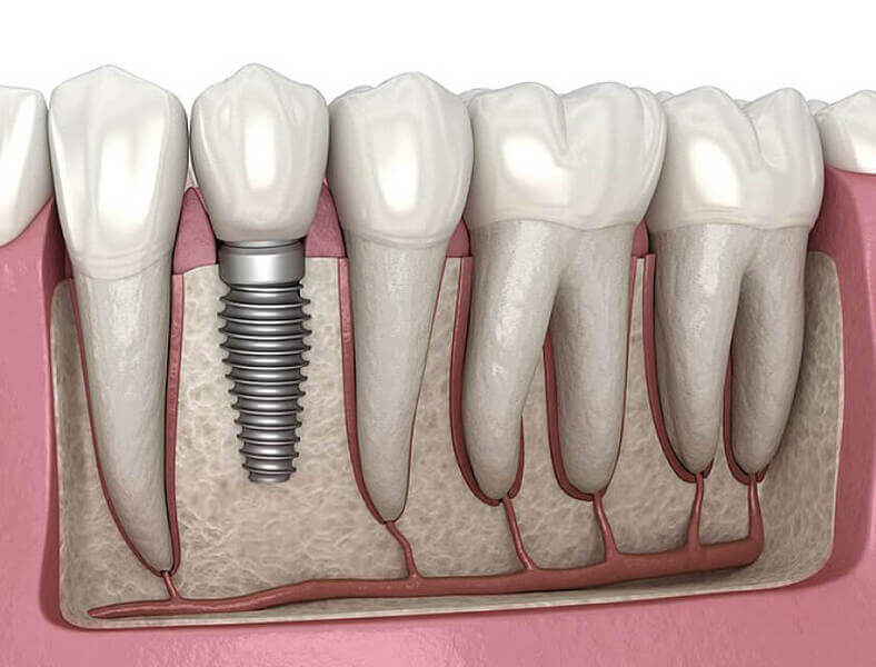 Straumann Dental Implants: A Revolutionary Solution for a Confident Smile